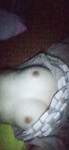 Vú bao căng
